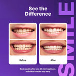 DENTYXO™ SMILE Whitening Strips - 14 Strips 1 Pack